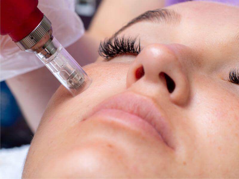 جوانسازی با میکرونیدلینگ و ترمیم با پماد زینک اکساید