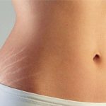 استرچ مارک بدنی یا ترک پوستی در سعادت آباد تهران