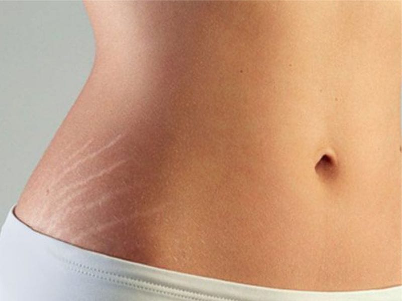 استرچ مارک بدنی یا ترک پوستی در سعادت آباد تهران